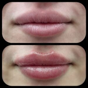 Lip Filler