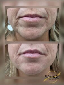 Lower face rejuvenation