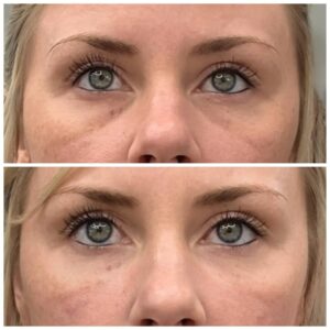 Undereye rejuvenation